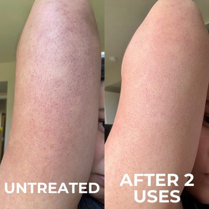GlaceAura Triple-Acid Complex for Keratosis Pilaris