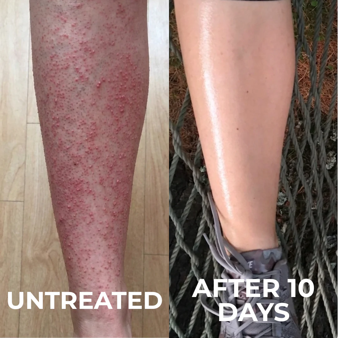 GlaceAura Triple-Acid Complex for Keratosis Pilaris