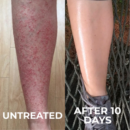 GlaceAura Triple-Acid Complex for Keratosis Pilaris